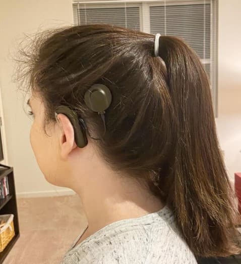 Side view of patient with cochlear implant.